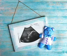 Внематочная беременность: определение, причины